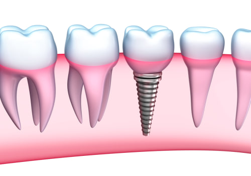 Achieve A Perfect Smile With Dental Implants: Unveiling The Journey Through Dental X-Rays In Austin, TX