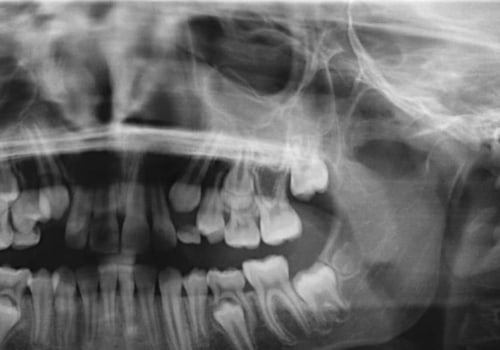 Where are dental x-rays developed?