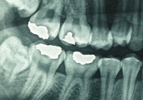 Can dental x rays be wrong?