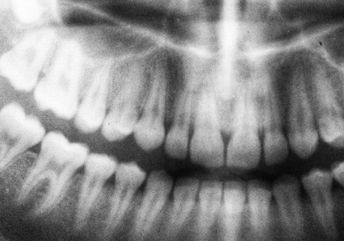 Are dental x-rays bad for you?