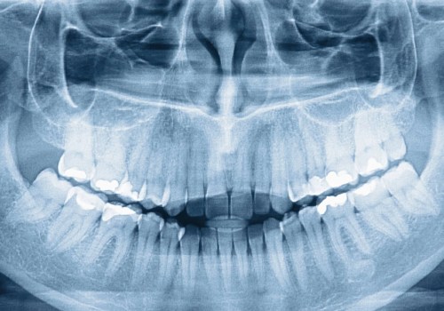 The Role of Dental X-Rays in Orthodontics in Seattle