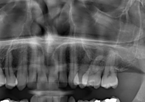 Can dental x-rays be harmful?