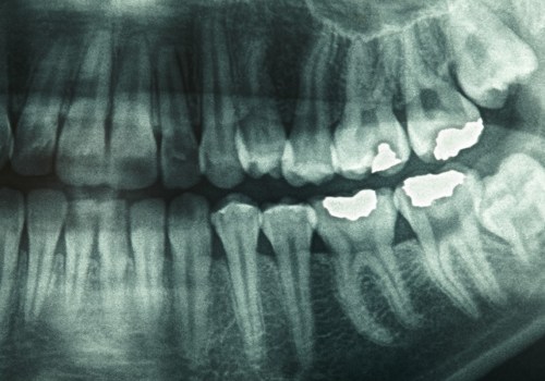Should i worry about dental x-rays?