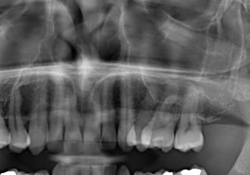 Can dental x rays show oral cancer?