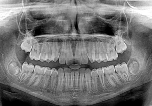 Are dental x rays needed every 6 months?