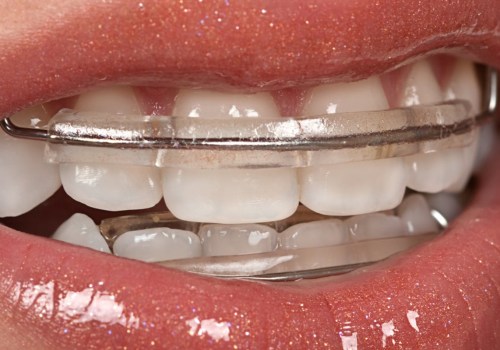 Why Dental X-rays Are Crucial For Proper Braces Placement In Georgetown And Austin
