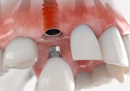 Which dental x ray gives the least amount of radiation?