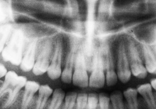 What Is The Importance Of Dental X-Rays In Dentistry In Austin, TX