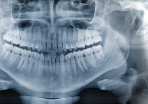 How Dental X-Rays Help Detect Problems Before They Become Serious