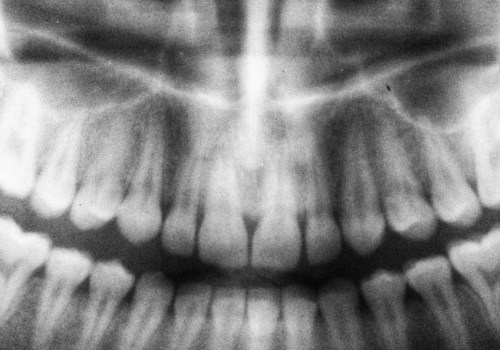 Dental X-Rays In San Antonio: Why They Are Essential For Good Oral Health