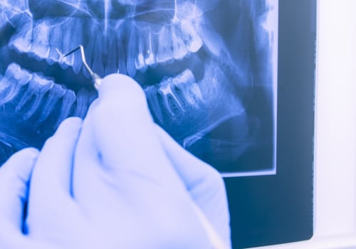 Why Dental X-Rays Are Essential Before Getting Dentures In Woden