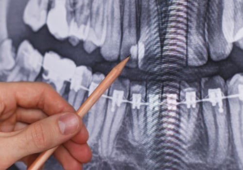 Do dental x-rays have a lot of radiation?