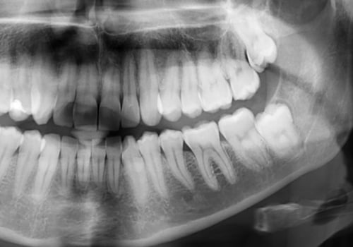 Enhancing Your Oral Health: The Importance Of Dental X-Rays From Ellsworth Dentists
