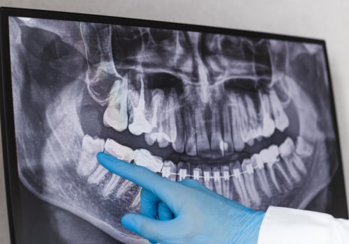 Understanding Dental X-Rays: A Guide From Your Borger Dentist